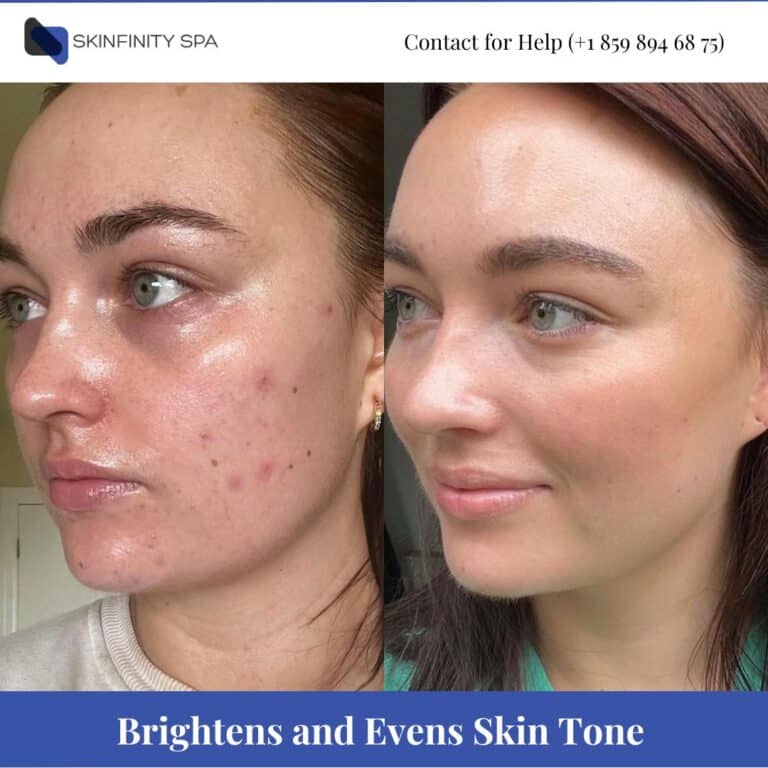 Jessner Peel Brightens and Evens Skin Tone