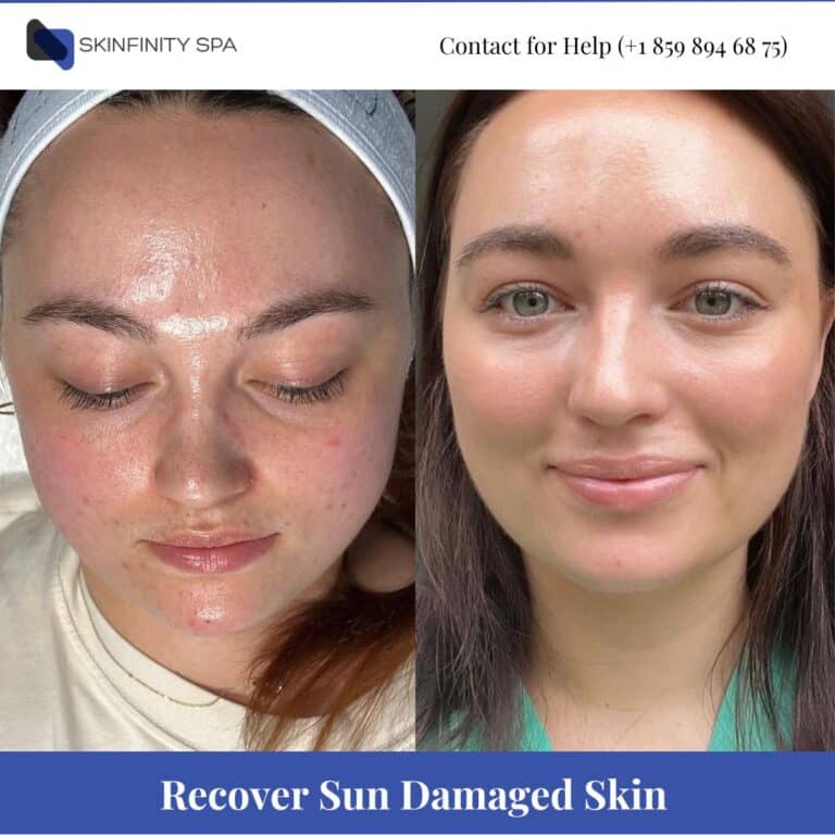 Recover Sun Damaged Skin