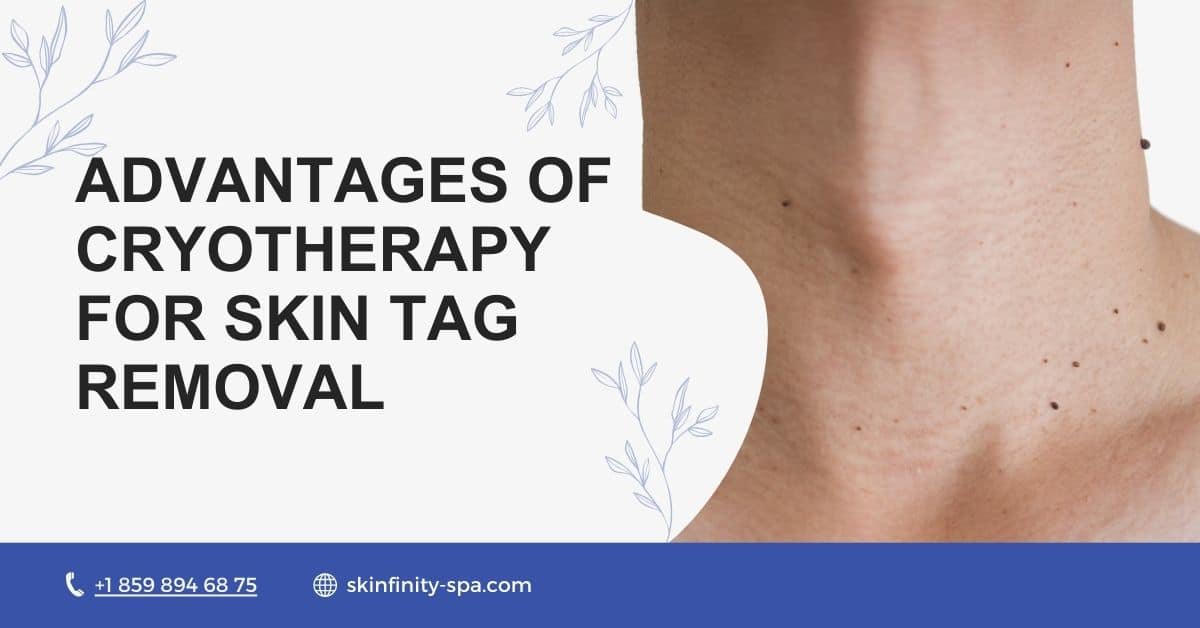 Advantages of Cryotherapy for Skin Tag Removal