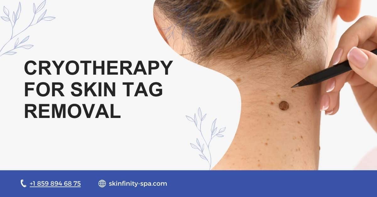 Cryotherapy for Skin Tag Removal