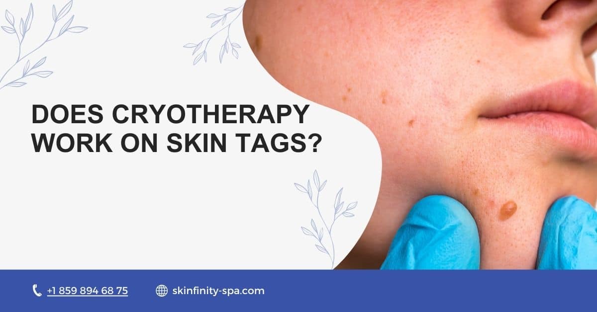 Does Cryotherapy Work on Skin Tags