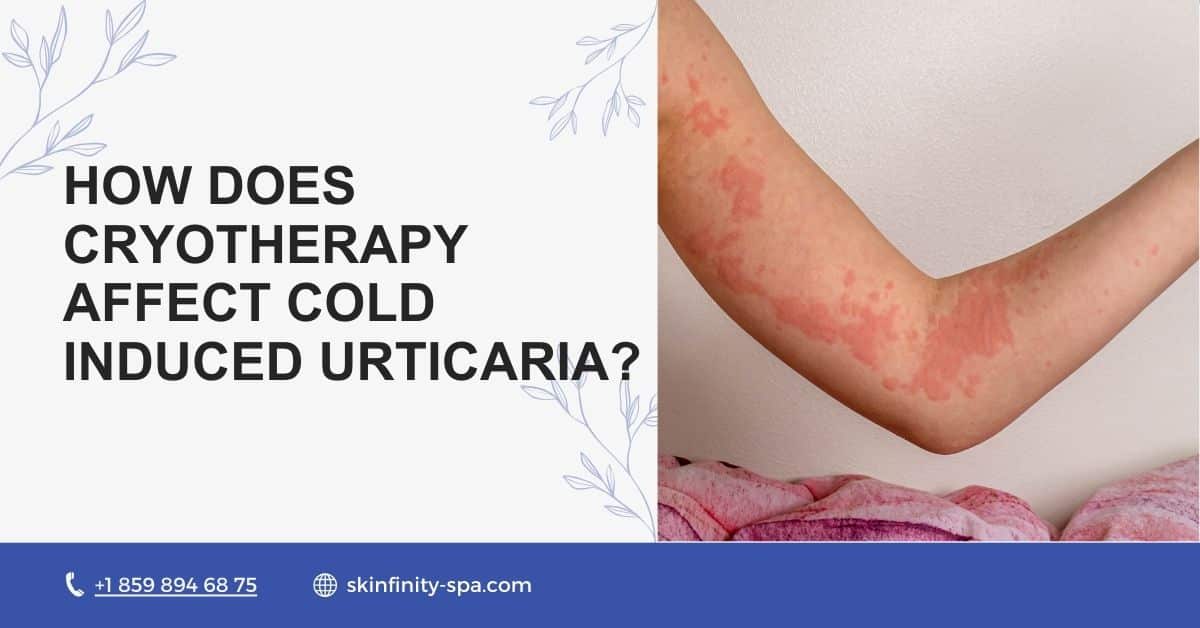 How Does Cryotherapy Affect Cold Induced Urticaria