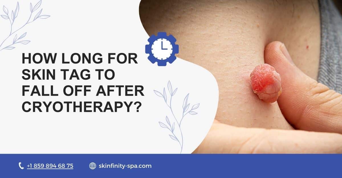 How Long for Skin Tag to Fall Off after Cryotherapy
