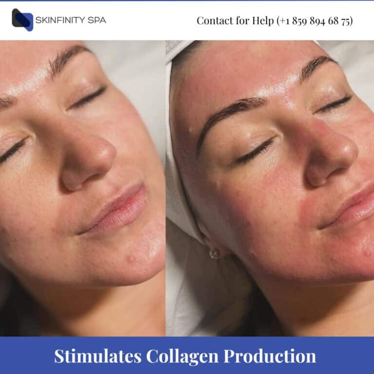 Micro needling Stimulates Collagen Production