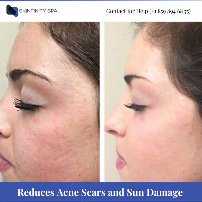 Microdermabrasion Reduces Acne Scars and Sun Damage