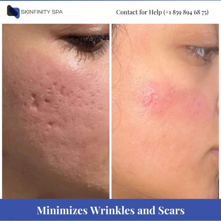 Microneedling Minimizes Wrinkles and Scars