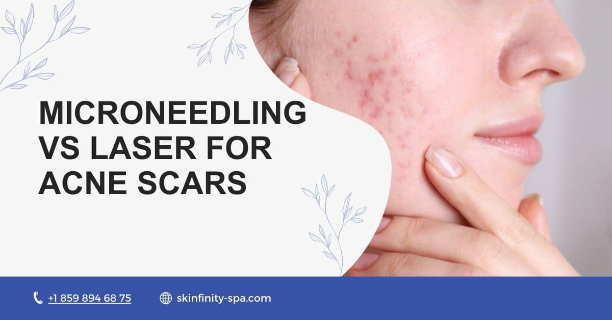 Microneedling vs Laser for Acne Scars