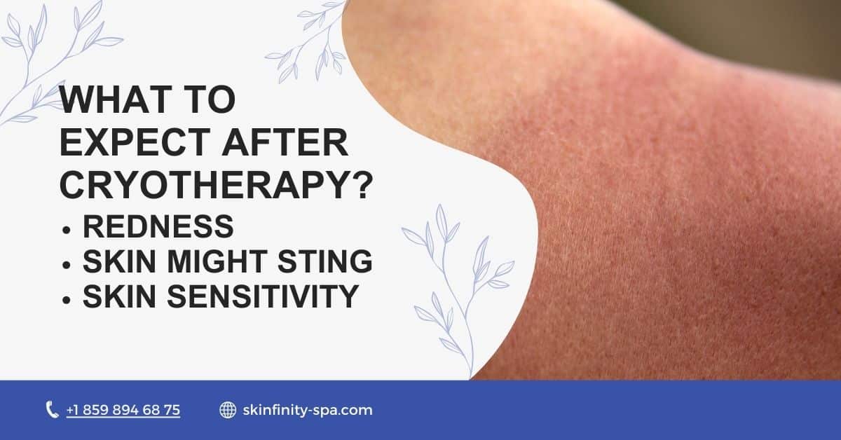 What to expect after cryotherapy