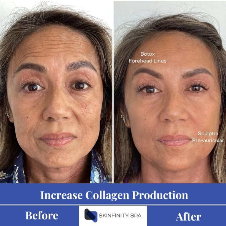 cryo face lift Increase Collagen Production