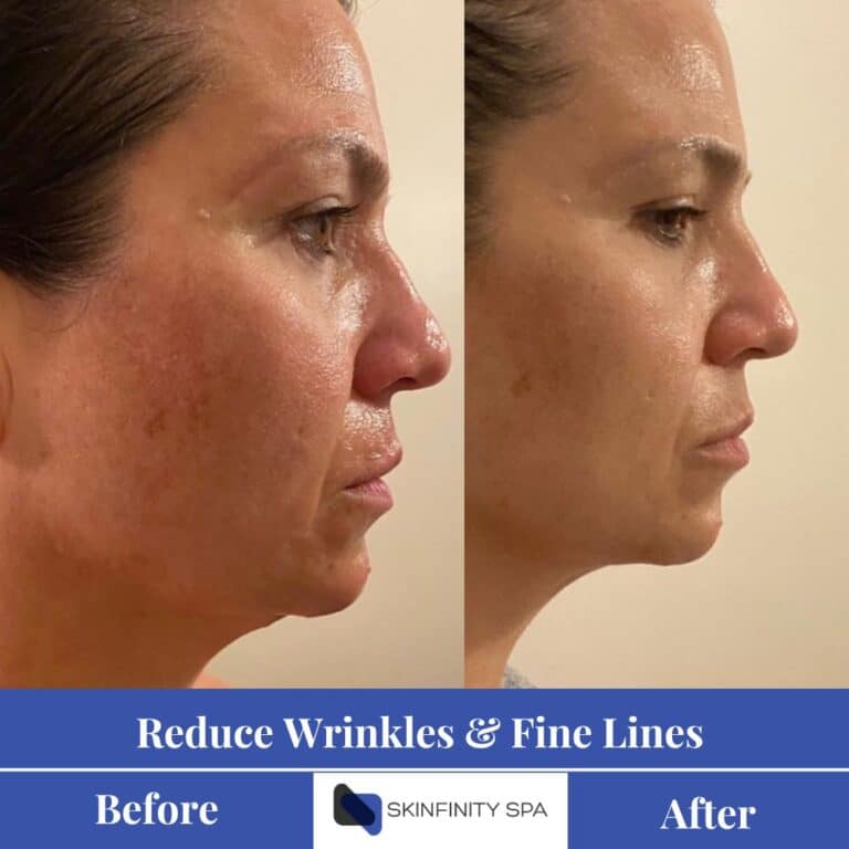 cryo face lift reduces wrinkles and fine lines