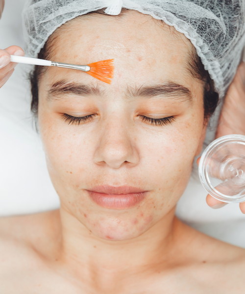 Facials for Acne Facials for Acne